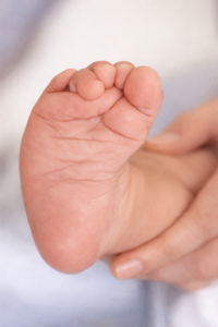 Pied de bébé avec avant-pied tourné vers l’intérieur (métatarsus adductus), malposition fréquente chez le nouveau-né