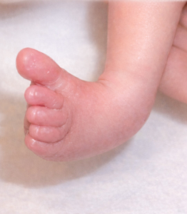 Pied de nourrisson tourné vers l’intérieur (pied varus ou supinatus), malposition souvent bénigne chez le nouveau-né