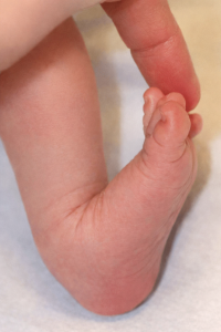 Pied de bébé relevé vers le haut en flexion dorsale (pied talus), position fréquente et généralement bénigne chez le nouveau-né